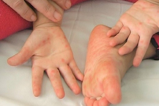 Tay chân miệng bùng phát mạnh, chuyên gia chỉ rõ 3 dấu hiệu cảnh báo bệnh trở nặng bố mẹ cần lưu ý