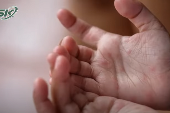 Cảnh báo thời điểm đỉnh dịch tay chân miệng