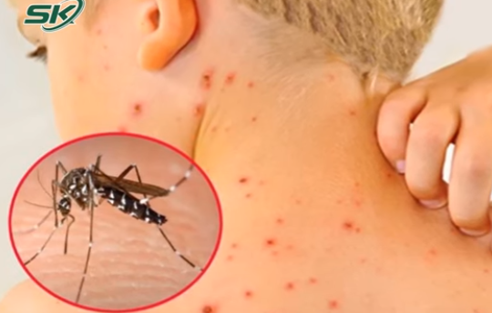 Dịch sốt xuất huyết diễn biến phức tạp, tăng khoảng 8.000 ca chỉ trong 1 tuần