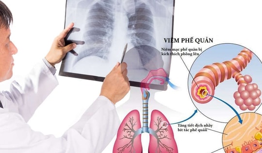 Viêm phế quản, điều trị thế nào để bệnh không tái phát?