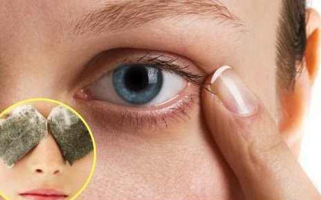 Đánh bay quầng thâm mắt tại nhà bằng 5 cách đơn giản