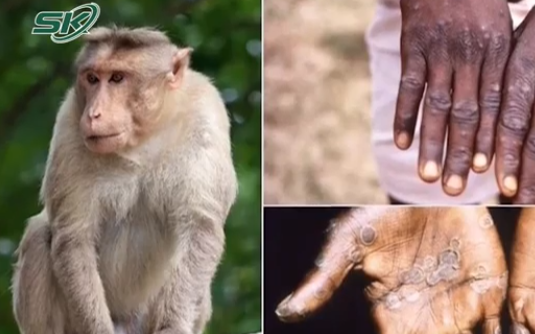 Thủy đậu khác với đậu mùa khỉ như thế nào? 