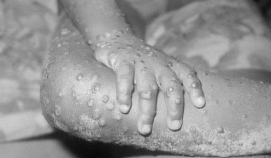 Chuyên gia nói gì về việc cách ly y tế đối với bệnh nhân mắc đậu mùa khỉ?