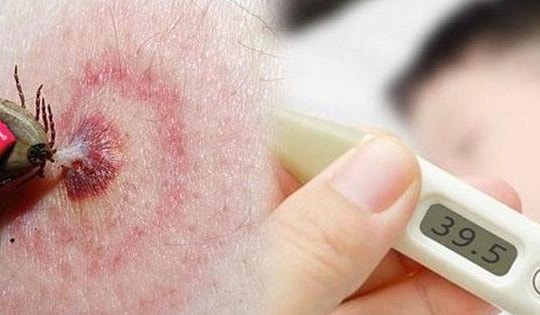 Liên tiếp các ca bệnh nhập viện do sốt mò, cần làm gì để phòng bệnh?