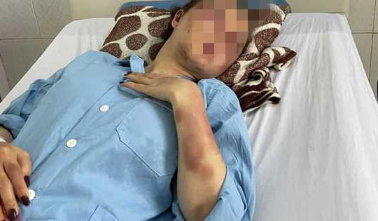 Công an vào cuộc vụ cán bộ QLTT đánh bạn gái dã man