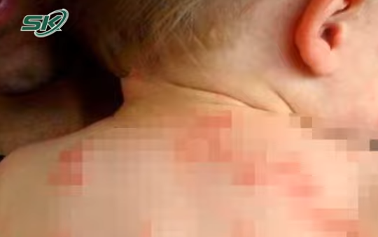 Báo động bệnh chốc lở lây lan mạnh khi trẻ tựu trường 