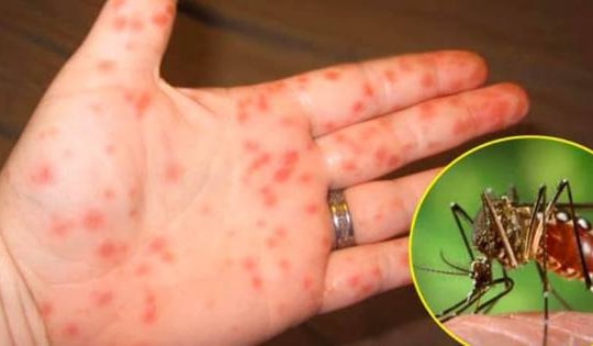 Đã có hơn 190.000 ca mắc, 72 trường hợp tử vong vì sốt xuất huyết