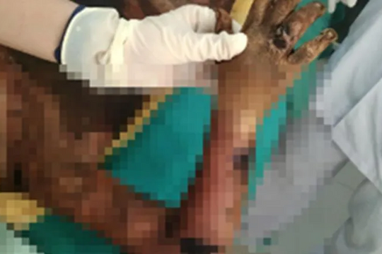 Bệnh nhi 5 tuổi bị nhiễm độc, nôn ra máu do gia đình đắp thuốc lá trị bỏng