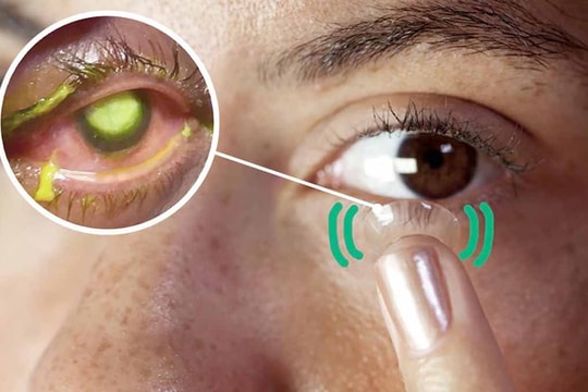 Đeo kính áp tròng coi chừng nhiễm trùng giác mạc lúc nào không hay