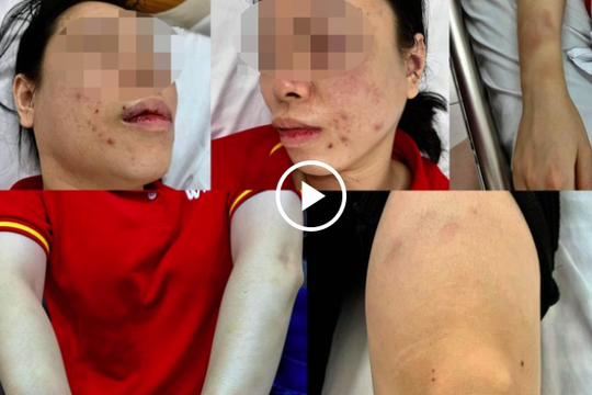 Nghi án người phụ nữ bị chồng cũ đánh đập, dã man