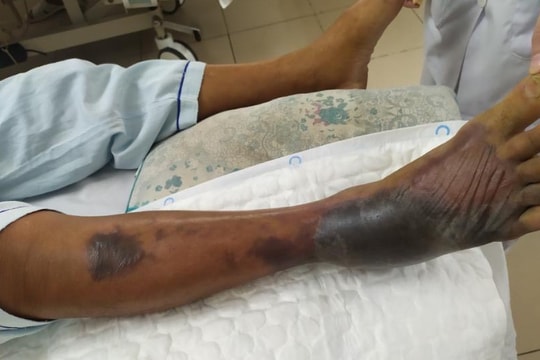 Hoại tử chân, nhiễm khuẩn huyết do vi khuẩn Vibrio vulnificus