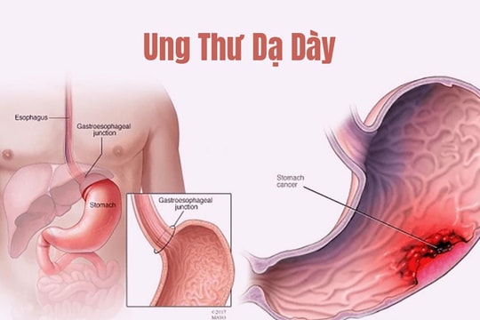 Ngày càng nhiều người trẻ mắc ung thư dạ dày