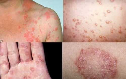 Bệnh lậu nguy hiểm với phụ nữ mang thai như thế nào?