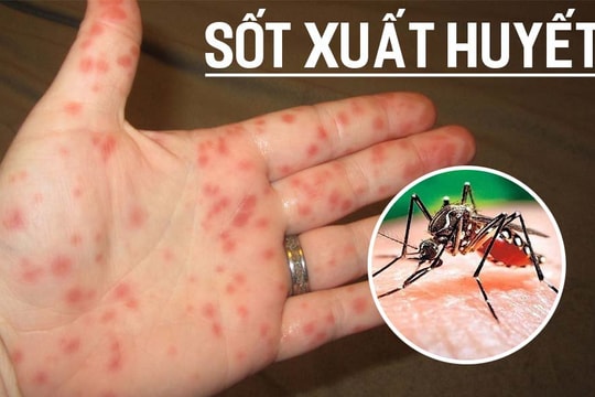 Dịch sốt xuất huyết ở Hà Nội diễn biến phức tạp, chuyên gia đưa ra khuyến cáo