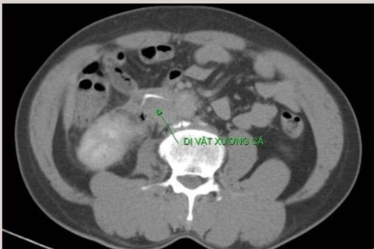 Cứu sống một ngư dân bị xương cá đâm thủng ruột