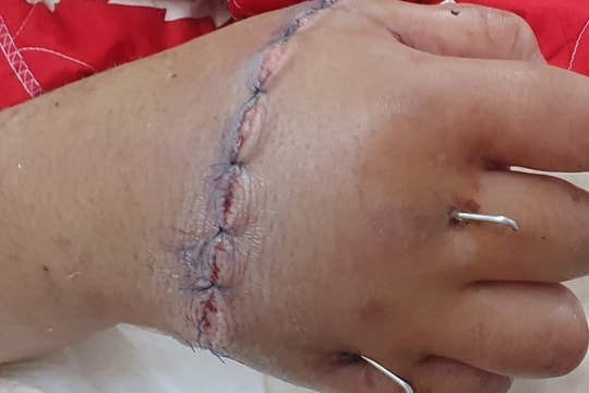 Mâu thuẫn với bạn, bé trai 12 tuổi bị chém đứt lìa bàn tay