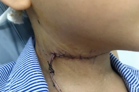 Mẩu gỗ dài 4cm bị 'bỏ quên' trong cổ bé 5 tuổi