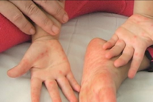 TP. Hồ Chí Minh: Số ca mắc sốt xuất huyết giảm, số ca mắc tay chân miệng gia tăng đáng kể