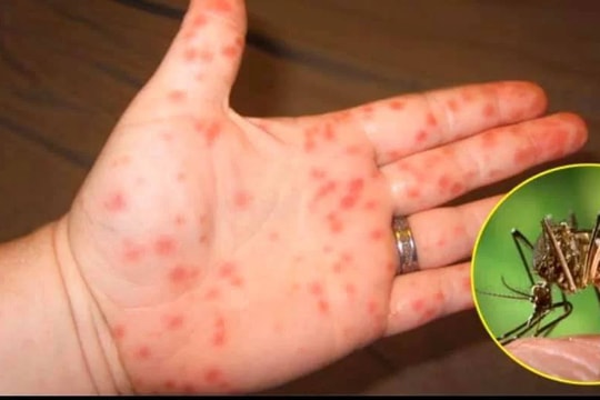 Bà Rịa - Vũng Tàu tiếp tục ghi nhận ca tử vong thứ 13 do sốt xuất huyết