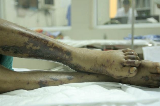 Hà Nội: Không ăn tiết canh nhưng vẫn mắc liên cầu khuẩn lợn