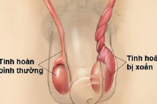 Xoắn tinh hoàn: Nguyên nhân, triệu chứng và phương pháp điều trị