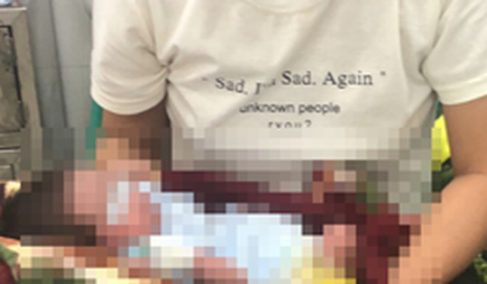 Nghệ An: Điều trị thành công trường hợp trẻ sơ sinh đẻ non, thoát vị thành bụng, teo ruột type 3b