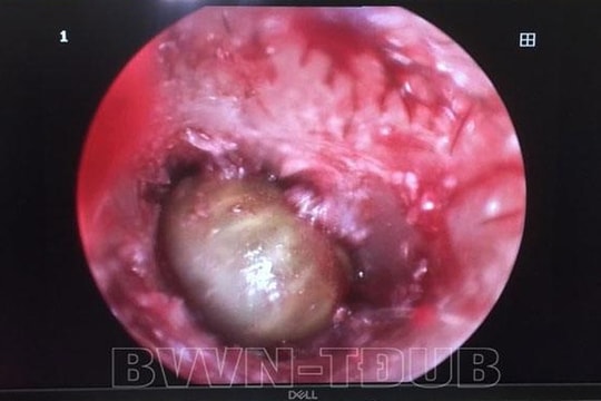 Gắp ve chó còn sống trong tai bé gái 2 tuổi