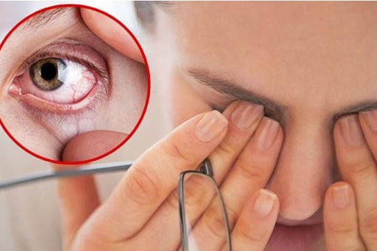 Những bệnh lý về mắt thường gặp sau bão lũ