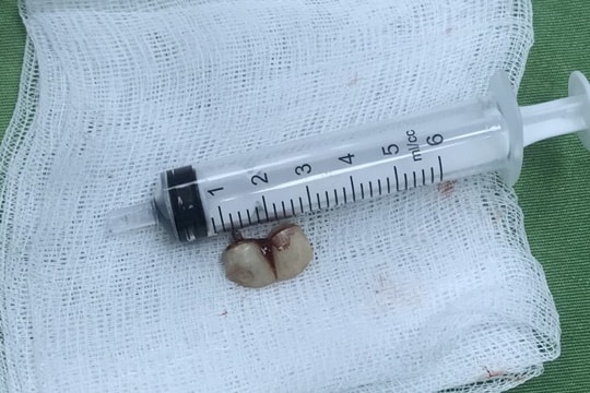 Quảng Ninh: Người phụ nữ nhập viện vì 2 chiếc răng giả trong phế quản