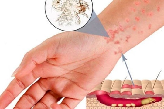 Chuyên gia hướng dẫn 10 bài thuốc trị ghẻ đơn giản từ từ cây cỏ 