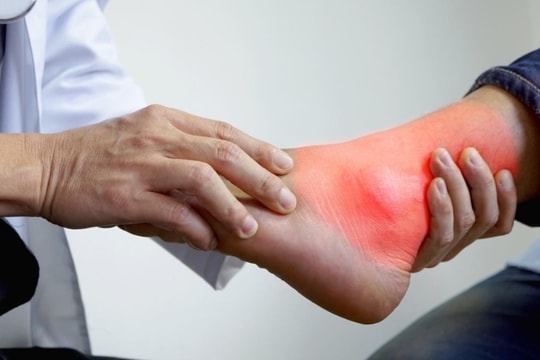 Cách sử dụng tinh dầu giảm đau khi bị gout