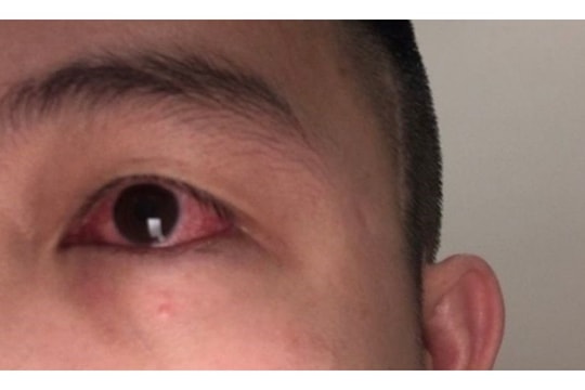 Hải Dương cảnh báo tình trạng bệnh đau mắt gia tăng