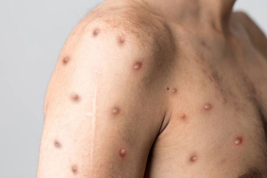 Bộ Y tế thông tin về ca bệnh đậu mùa khỉ đầu tiên ở Việt Nam