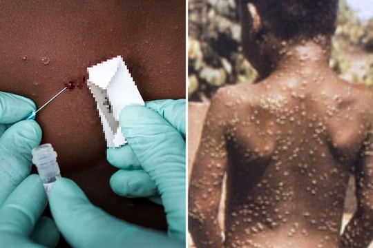 106 nước trên thế giới ghi nhận ca mắc bệnh đậu mùa khỉ