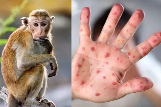 Ghi nhận ca bệnh đậu mùa khỉ đầu tiên tại TP. HCM, cần làm gì để tránh nhiễm bệnh?