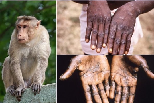 Đồng Nai: Chủ động xây dựng phương án phòng bệnh đậu mùa khỉ