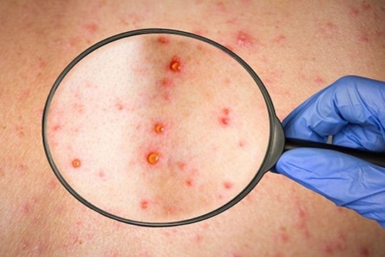 Trước khi ghi nhận ca mắc đậu mùa khỉ đầu tiên, Việt Nam đã làm gì để ứng phó?