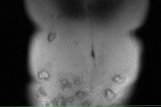 Người phụ nữ bị hoại tử vùng bụng sau khi tiêm tan mỡ bụng