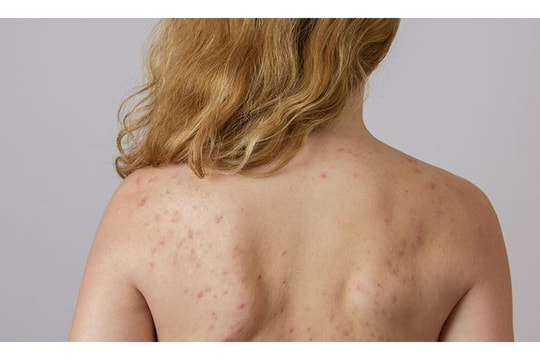 Những điều cần ghi nhớ để trị mụn lưng hiệu quả tại nhà