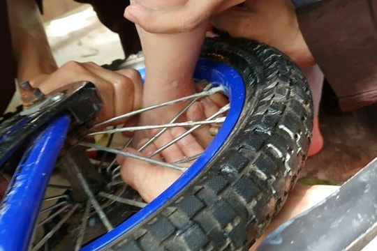 Bé gái 2 tuổi bị dập nát phần mềm gót chân do kẹt vào nan hoa xe đạp