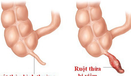 Vì sao nên phẫu thuật ngay khi bị viêm ruột thừa