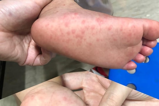 Đắk Lắk: Bệnh tay-chân-miệng đang diễn biến phức tạp