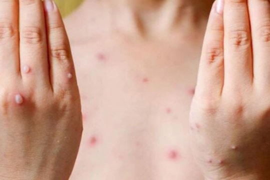Dấu hiệu để phân biệt đậu mùa khỉ với thủy đậu, tay chân miệng