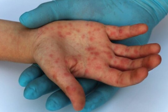 Đậu mùa khỉ lây truyền qua những đường nào, có phải là bệnh lây qua đường tình dục?