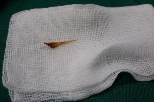 Cấp cứu thành công bệnh nhân thủng ruột do nuốt xương cá