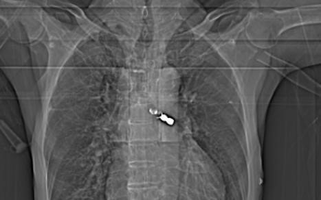 Cụ ông 92 tuổi đi làm răng, bị răng giả rơi vào phế quản