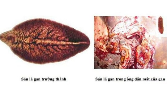 Triệu chứng thường gặp khi mắc bệnh sán lá gan 