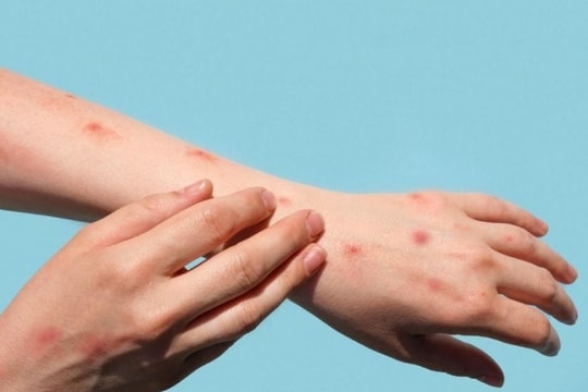 Đắk Lắk: Lên phương án hành động tạm thời phòng, chống bệnh đậu mùa khỉ