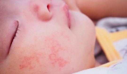 Chăm sóc trẻ viêm da cơ địa đúng cách khi thời tiết chuyển mùa