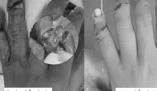 BV Nhi Trung ương phẫu thuật nối 2 ngón tay gần đứt rời cho bé trai 7 tuổi